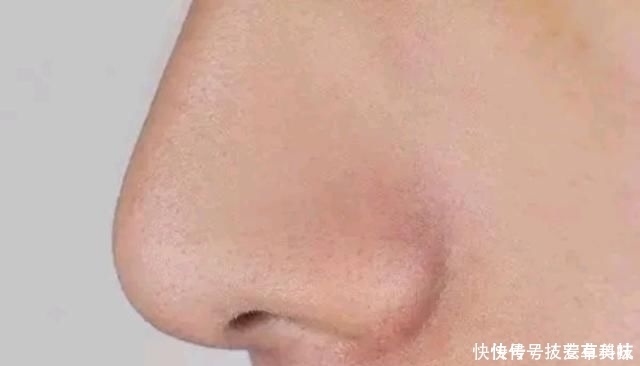 『黑头和粉刺』鼻子里面挤出来“白色小芝麻”,越挤越畅快?劝你别乱挤了