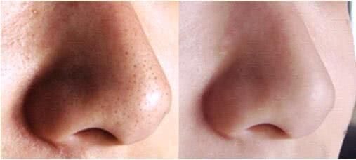 长了“黑头”怎么办？教你2招，让黑头自己跑出去，还不伤皮肤！