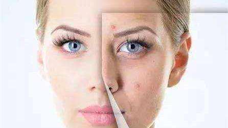 螨虫天天在脸上打洞,用这1招,脸蛋变得白白净净,开开心心等待开学