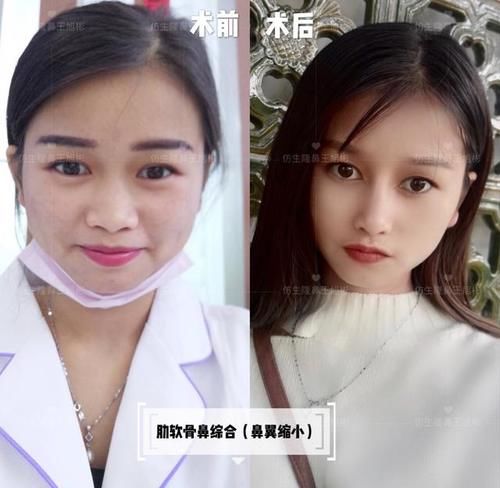  术后■鼻头肥大、山根低、没鼻梁，肋软骨隆鼻后变化有多大？