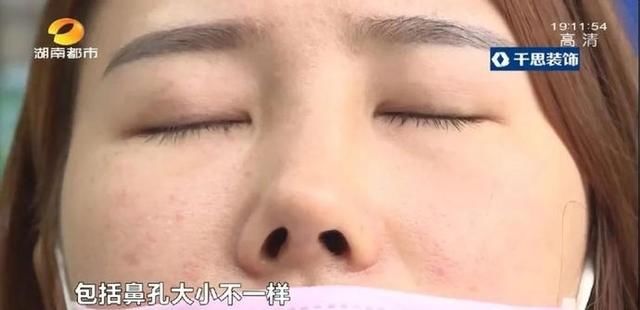  术后：女子花6.5万元隆鼻，术后鼻梁明显偏移，三个月仍未恢复，机构回复：可能是你自己碰的……