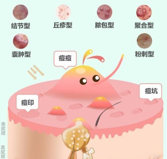  [皮肤]痘痘，痤疮，是螨虫形成的吗？有讲解预防缓解方法！
