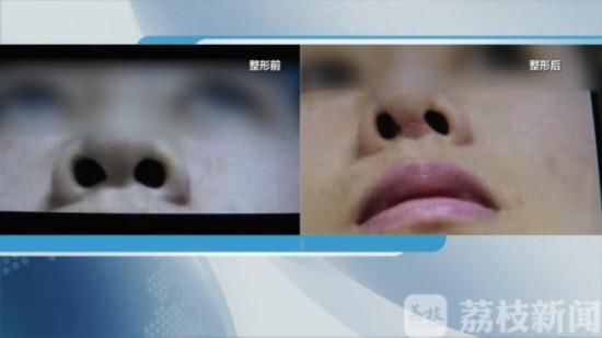  「修复」女子在南京施尔美整形医院隆鼻后鼻子歪了 修复后更歪了