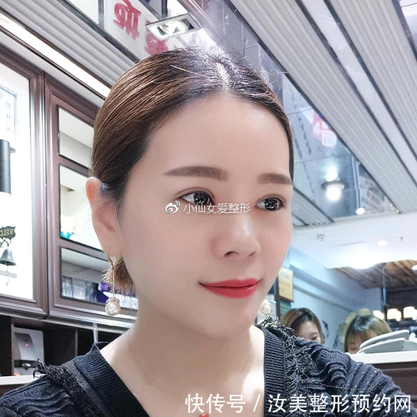 开内眼角前后对比照片，不灵不灵的大眼睛也着实的迷人