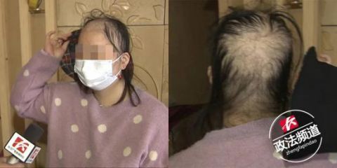  『养发』长沙女子做头发护理后变“秃头” 店家这么回应