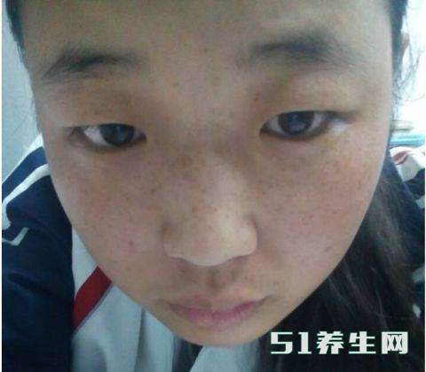 满脸长斑点易显老, 大姐只用牙膏加上“它”, 仅需数周斑点全消失