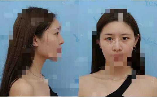 北京艺星割双眼皮确实是对的选择,气质好了