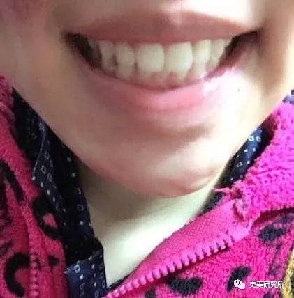 “整牙到底能不能瘦脸”终于有了权威结论，杨幂竟是被冤枉的?