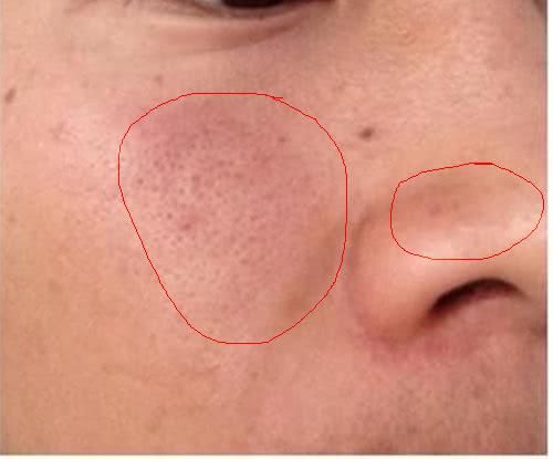 脸上毛孔里“堆满”了螨虫,皮肤会有3反常,2方法拎出来