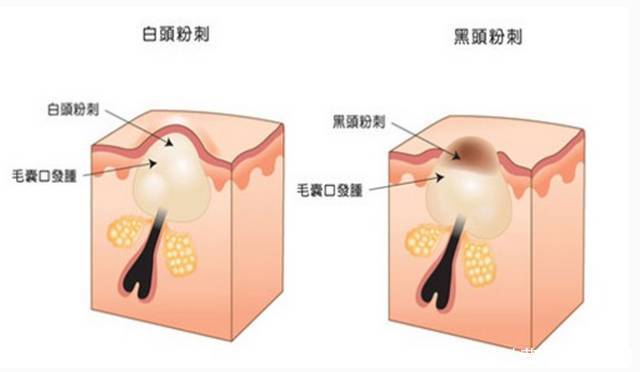 你知道,脸上的“小疙瘩”,挤出来的“白色条状物”,是什么吗?