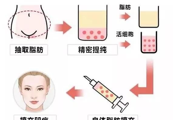  『手术』自测！自体脂肪填充脸上凹陷疤痕效果怎么样？