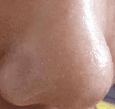 鼻头里挤出这么多“小黄粒”,证明脸上螨虫过亿，3招教你逼退螨虫