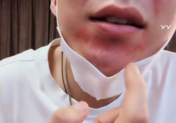 摩登兄弟下巴严重过敏回应戴口罩装明星,利哥怼黑粉:你穷,该!