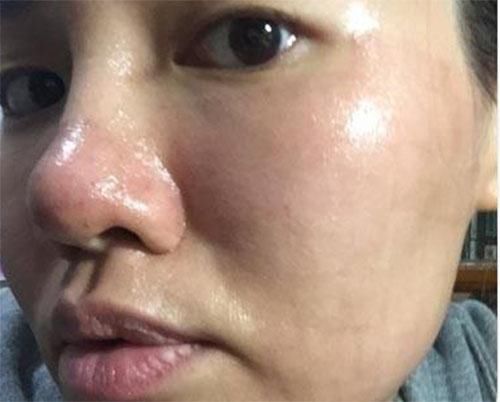 脸上毛孔里“堆满”了螨虫,皮肤会有3反常,2方法拎出来