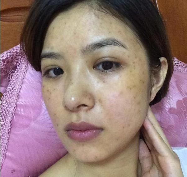 白醋洗脸的正确美白方法，七天美白，十天祛斑