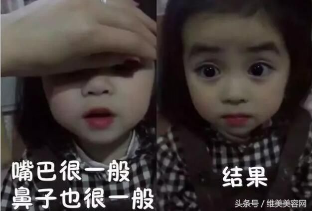 把单眼皮变成双眼皮，居然是这样做的