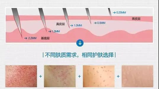 「皮下组织」热门医美项目“水光针”,真的有效果吗?