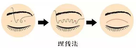 北京八大处杨欣专家:双眼皮术式该怎么选