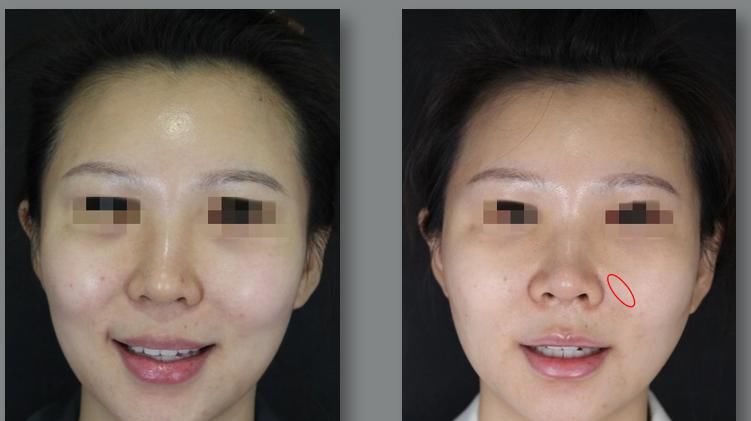  【影响】鼻基底凹陷畸形矫正临床策略及手术对面部表情的影响