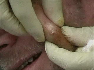 鼻子上为什么会有黑头？本文黑头图片高能警报，没做好准备勿看！