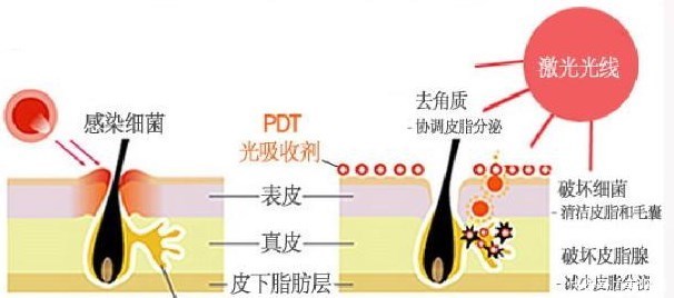  「皮肤」皮肤杀手——粉刺，怎么破？