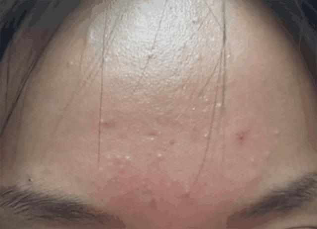 螨虫“聚积”毛孔，脸上4个部位会说话，3方法自测揪出