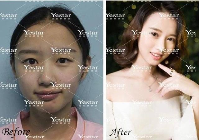  【明明】明明眼睛比之前大了，却越来越丑？这是什么操作