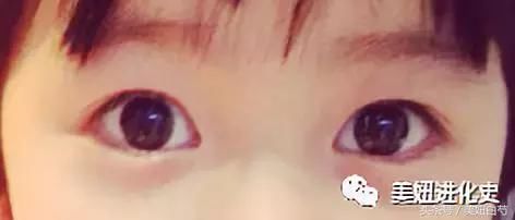 为什么她做了双眼皮却没有变美？