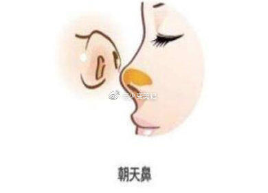  『鼻翼软骨』那么哪些鼻型适合做隆鼻手术