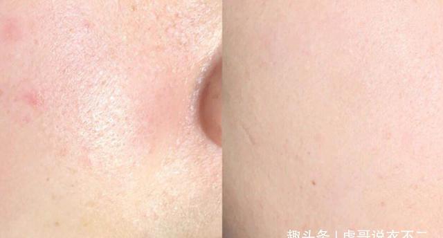 顺利@敏感肌如何应对“换季”?这3点要注意,助你顺利度过换季时期