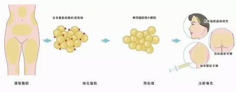 「自体脂肪移」还在嫌弃脂肪“油腻”？那是因为你没有物尽其用