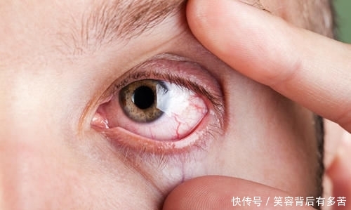 『眼皮』眼皮下垂怎么自然恢复?眼皮为什么会下垂?