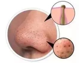 黑头越来越多?黑头里面挤出来的东西原来是这些!