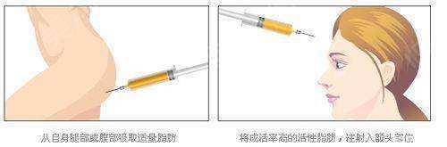  「自体脂肪丰额头」额头扁平，侧颜不好看怎么办？这样做，让你侧颜立体感爆棚！