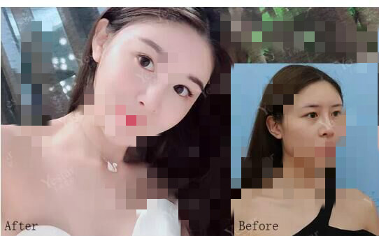 北京艺星割双眼皮确实是对的选择,气质好了