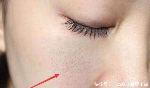  『油脂』毛孔粗大是因为螨虫挤大，三方法有效除螨, 排空毛孔螨虫