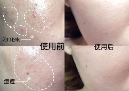  『好变』别再盲目“刷酸”了，刷好了皮肤像剥壳的鸡蛋，没刷好变敏感肌