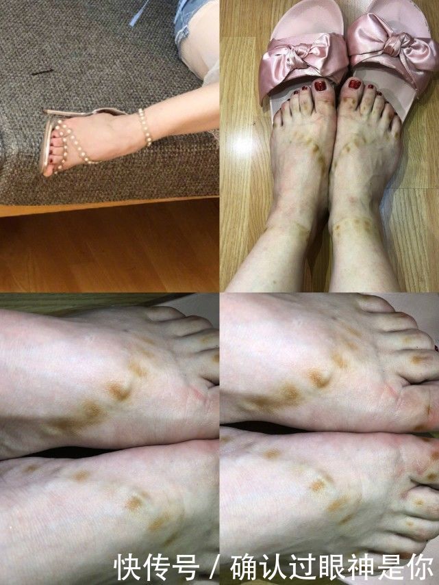 女星高跟鞋真吓人，徐璐看着都疼，冉莹颖穿十个小时鞋脚触目惊心