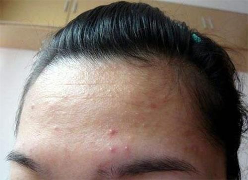 它们在你毛孔里面繁殖又排泄，难怪你的痘痘总是不好，2招搞定