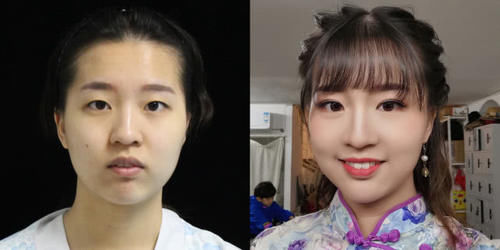  #术后恢复#为什么说春季是医美旺季？最适合整形项目大盘点，必看！