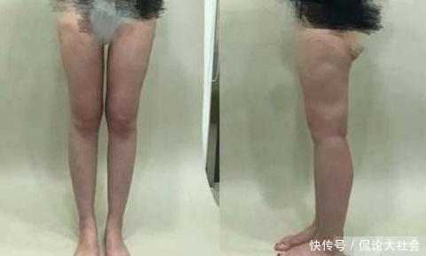 为拥有一双大长腿, 女子穿塑身裤长达六个月, 脱下那一刻女子哭了