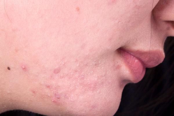 『脸上』脸部螨虫过多,脸上会有哪些变化教你四招,螨虫一点点被消灭