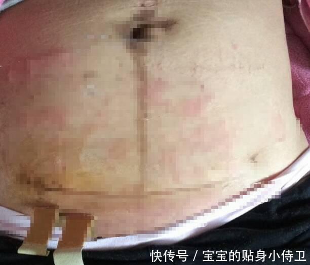 不管不问, 产妇自己照顾自己, 5天后产口溃烂流脓