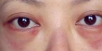  #生成太#表姐外切去眼袋术后眼睛发红，看不清, 去眼袋手术后眼睛淤血不会瞎吧！