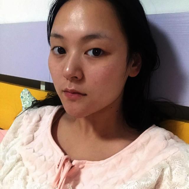 韩式双眼皮+开眼角能做出“桃花眼”吗？这篇真人案例值得参考！