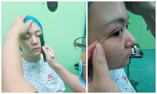 韩式双眼皮+开眼角能做出“桃花眼”吗？这篇真人案例值得参考！