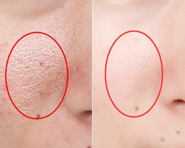 女人毛孔粗大很粗糙，用蛋清和小颗粒混合敷脸，3天收毛孔除暗黄