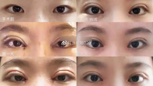  【内眦赘皮矫】需不需要看眼角……请对号入座