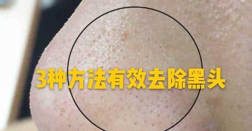  #后均匀的涂#和黑头说拜拜！三种方法教你去黑头，朋友说：用完后黑头全没了