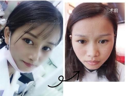  术后■鼻头肥大、山根低、没鼻梁，肋软骨隆鼻后变化有多大？